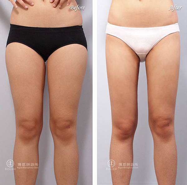 大腿抽脂,大腿抽脂案例,抽脂手術,李岳樺醫師,博恩妍